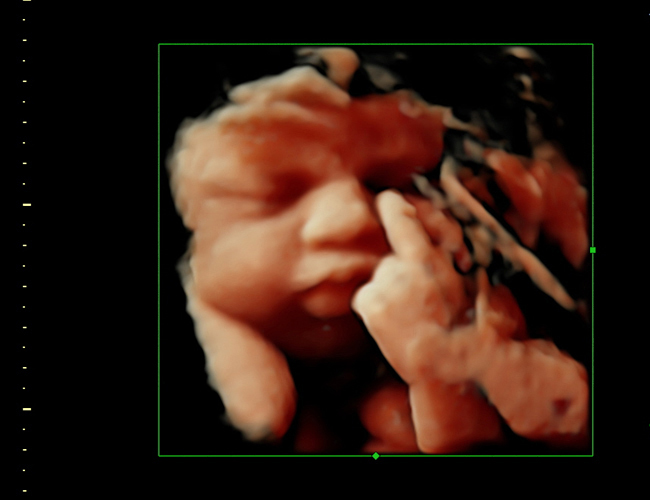 3D ultrasound image at 33 weeks